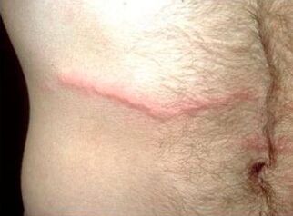 How to get rid of subcutaneous parasites to people
