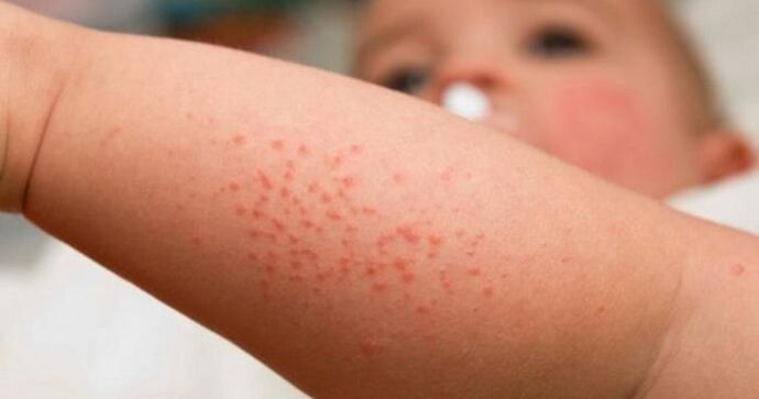 Redness of the skin as a symptom of parasite infection